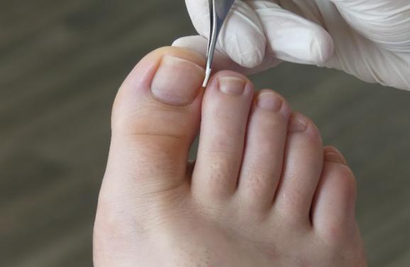 ongle incarné traitement