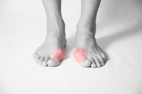 hallux valgus podologue