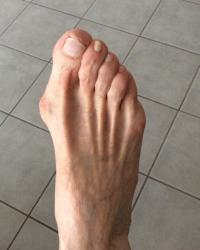 Hallux valgus Dax Hallux valgus Dax